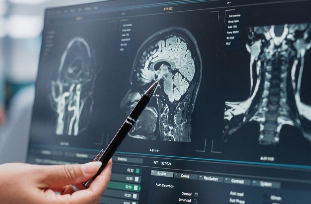 Brain Injury Lawyers in San Jose